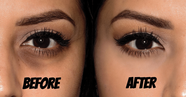 Get Rid Of Dark Circles Under Your Eyes With These 10 Home ...