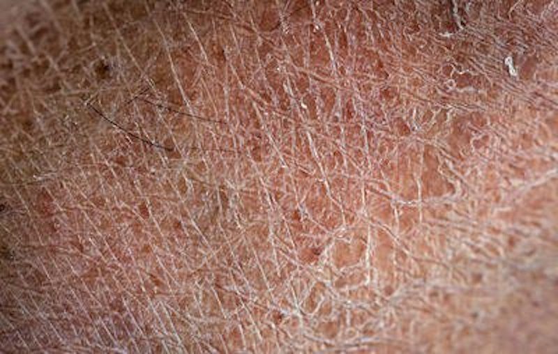 10 Signs That You Have Mold Illness Daily Wheezing One Of The Most Commonly Observed Symptoms Related To Mold Exposure Is Inhalation Tiny Spores Could Cause Your Throat Lining