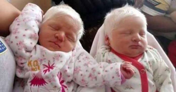 Rare Albino Twins Born With Gorgeous Snow White Hair Jesus Daily