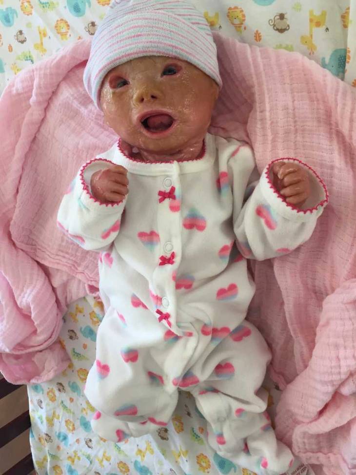Doctors Forced To Do Emergency C Section Then Stunned When Baby Has Rare Condition Called Harlequin Ichthyosis Jesus Daily Doctors Forced To Do Emergency C Section Then Stunned When Baby Has Rare Condition Called Harlequin Ichthyosis Jesus Daily